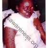 17 year old with stevens - jonson syndrome